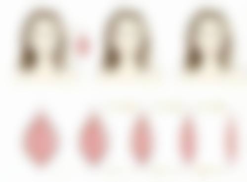 一、做完双眼皮后睡觉姿势的讲究