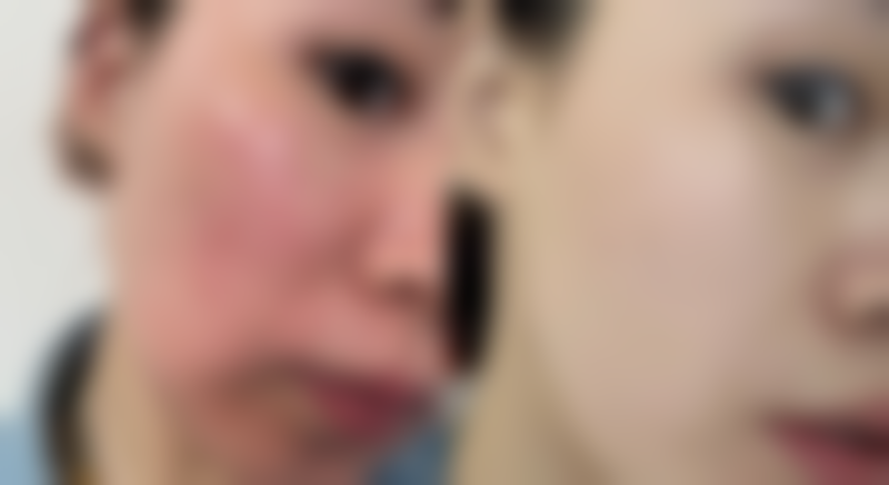 一、了解双眼皮哭肿的原因