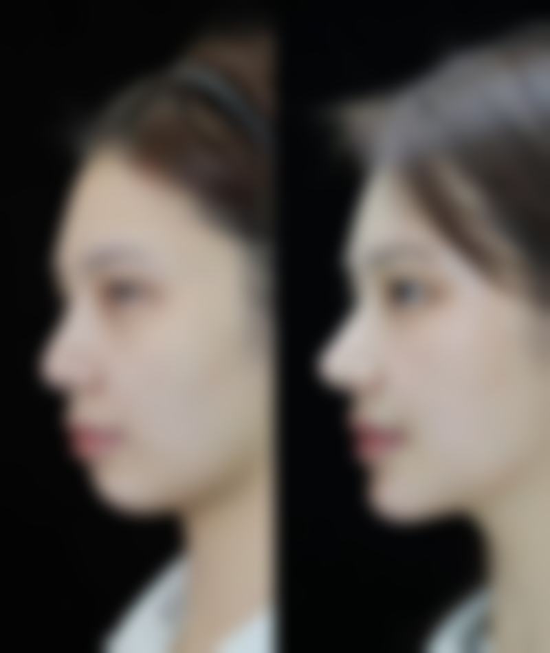 一、烫伤疤痕印怎么去掉之了解烫伤后疤痕的形成与类型