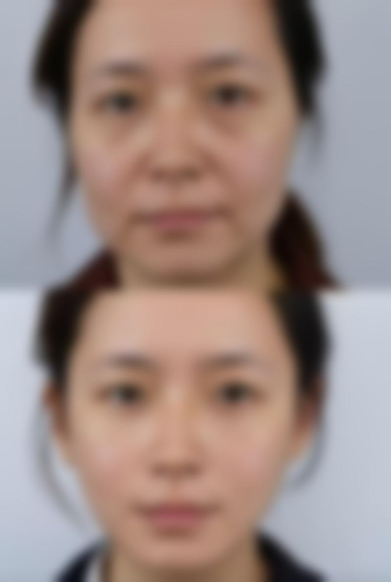 疤痕体质增生怎么治疗？多种科学方法助你有效改善疤痕增生状况 