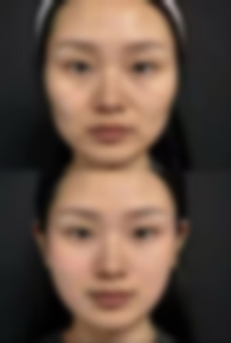 三、眼袋的类型及与熬夜的相关性