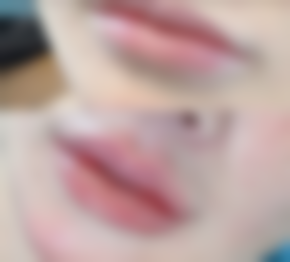 二、疤痕修复期间的饮食注意事项