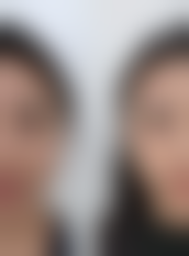 打除皱针脸部僵硬怎么能缓解？掌握这些方法助你加速恢复自然表情