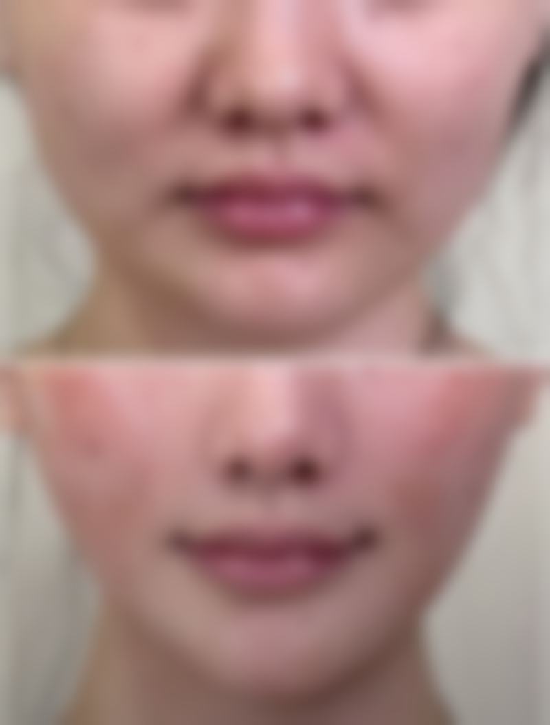 六、理性看待自体耳软骨隆鼻的“恒久性”