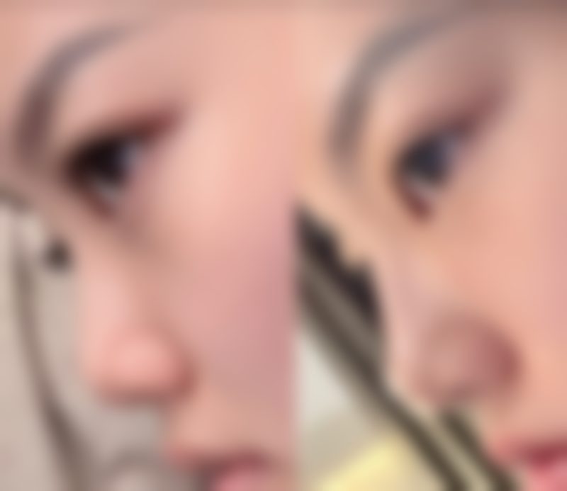 四、割双眼皮后年老时的注意事项