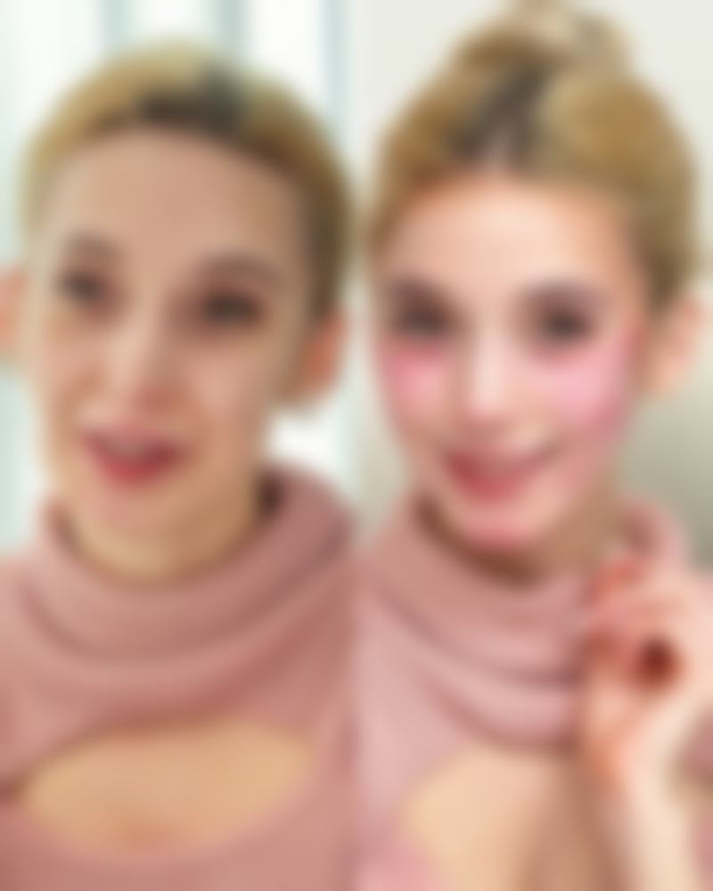 三、自体耳软骨隆鼻成效是否恒久的分析