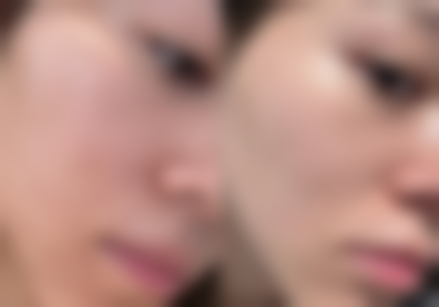 四、打除皱针脸部僵硬的美学与功能修复建议