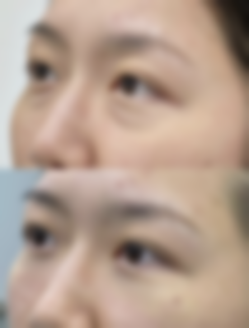 疤痕多久能治好么？不同类型疤痕消失时间大揭秘，这些因素影响恢复速度！ 