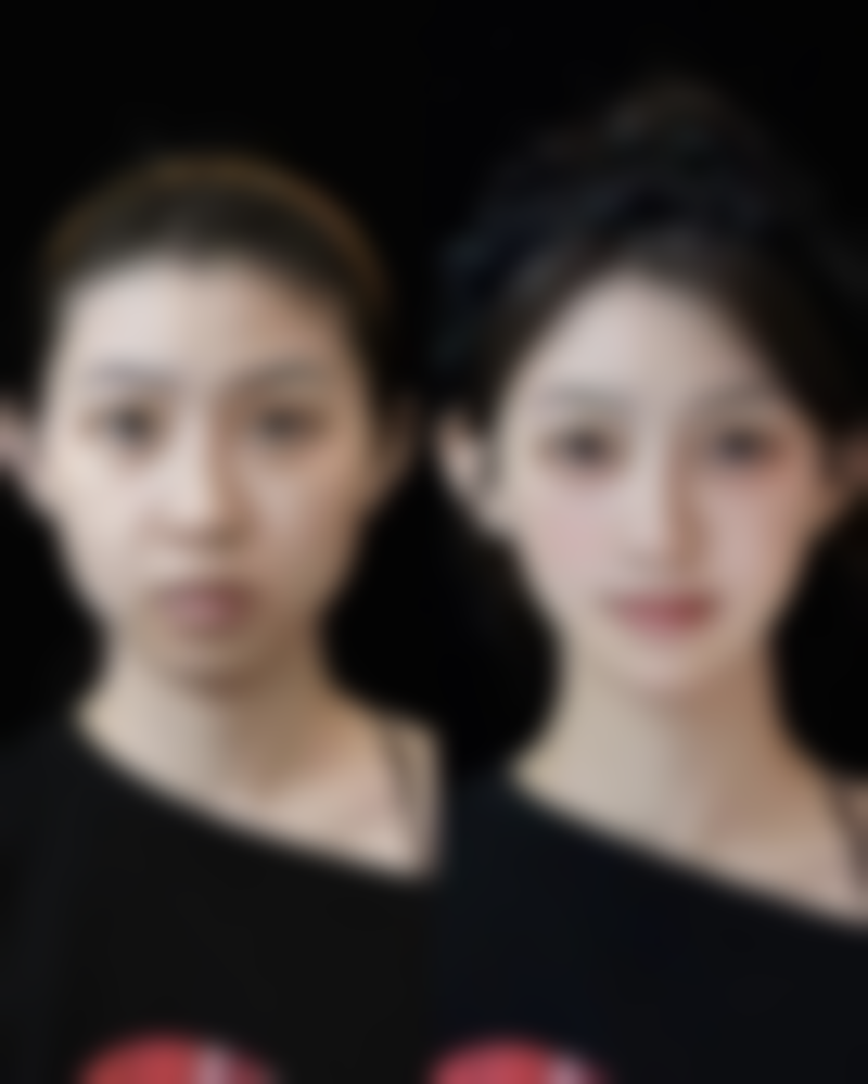 一、耳软骨隆鼻的优势