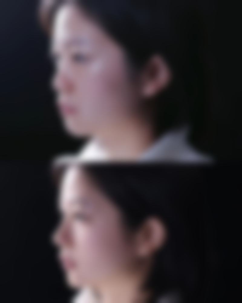 五、用自己脂肪隆胸与假体植入的对比