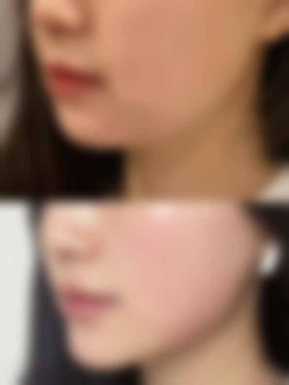 摔伤后疤痕凸起疙瘩怎么办？掌握这些治疗方法与护理要点助你有效祛疤！ 