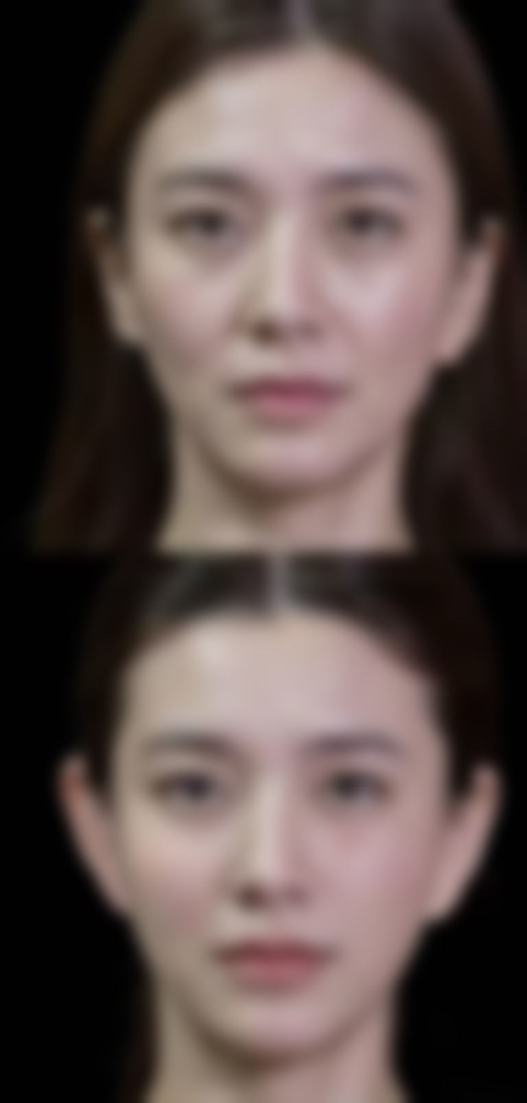 五、耳软骨隆鼻术后护理要点