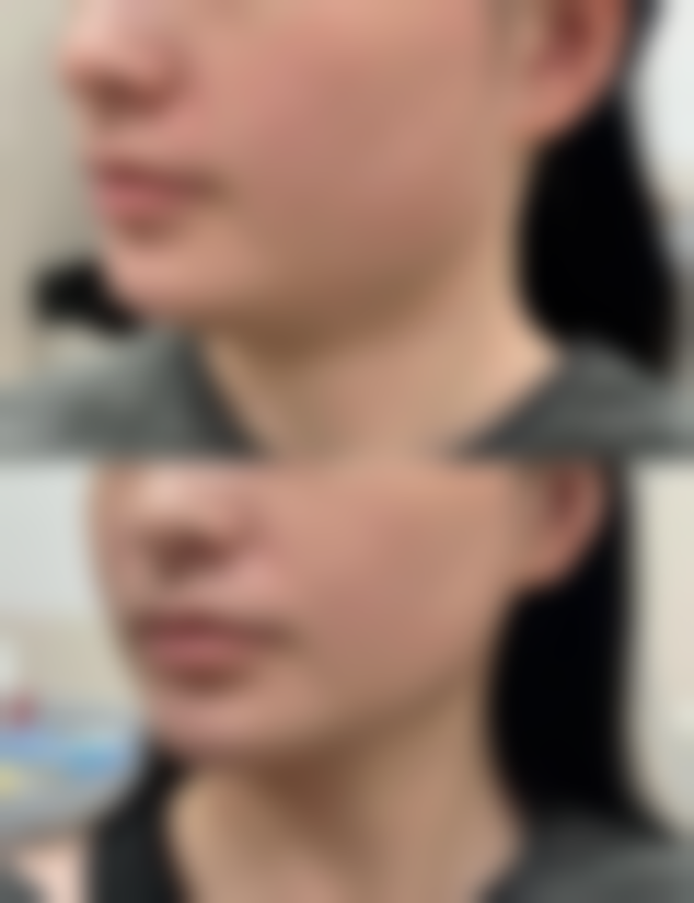 用自己脂肪隆胸好吗？女生看过来，自体隆胸优势、风险及适用情况全解析！ 