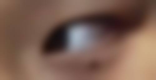 四、激光祛斑可能出现的反应及应对措施