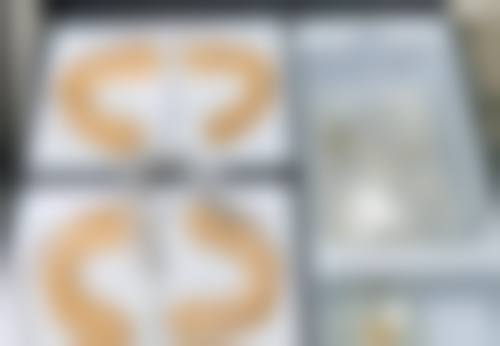 一、凹陷眼皮能否割双眼皮，得综合判断