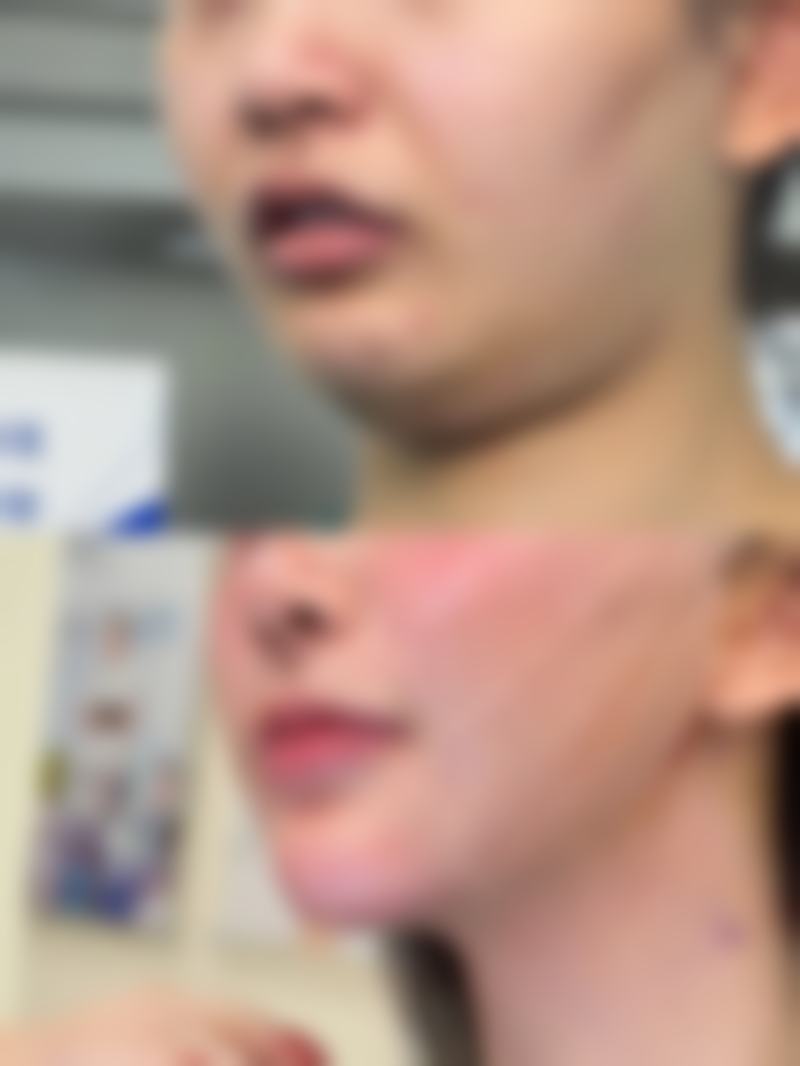 一、了解隆鼻后脸肿的原因和消肿时间