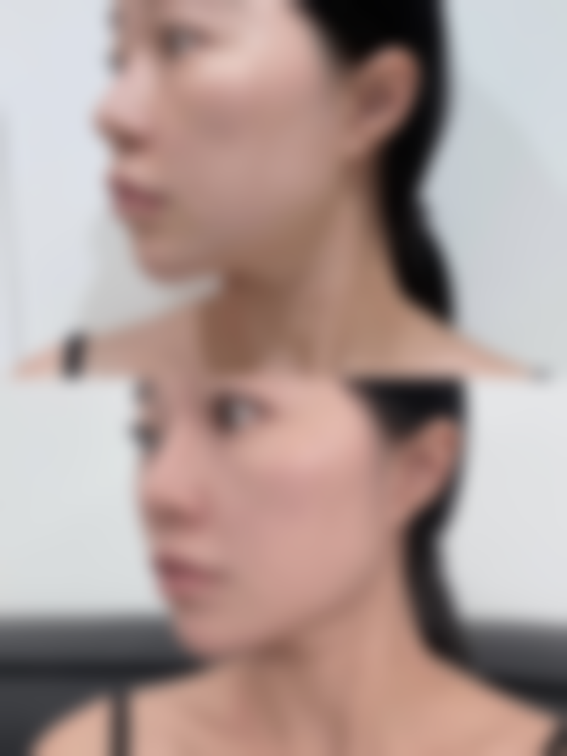 一、埋线双眼皮和全切的基本原理