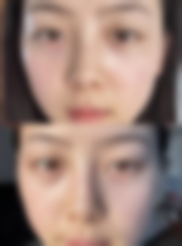 三、外用药物防止疤痕增生