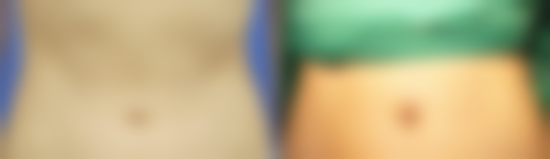 二、隆鼻有哪些什么害处之长期问题