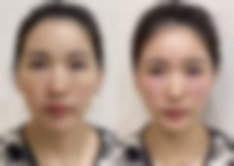 一、怎么去掉熬夜眼袋之了解眼袋类型与成因