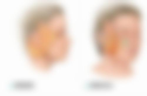 全切双眼皮25天还肿怎么办？了解20天状态及应对策略助你快速消肿