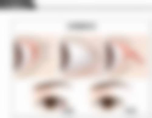 二、环切包皮手术术后修复的详细时间线