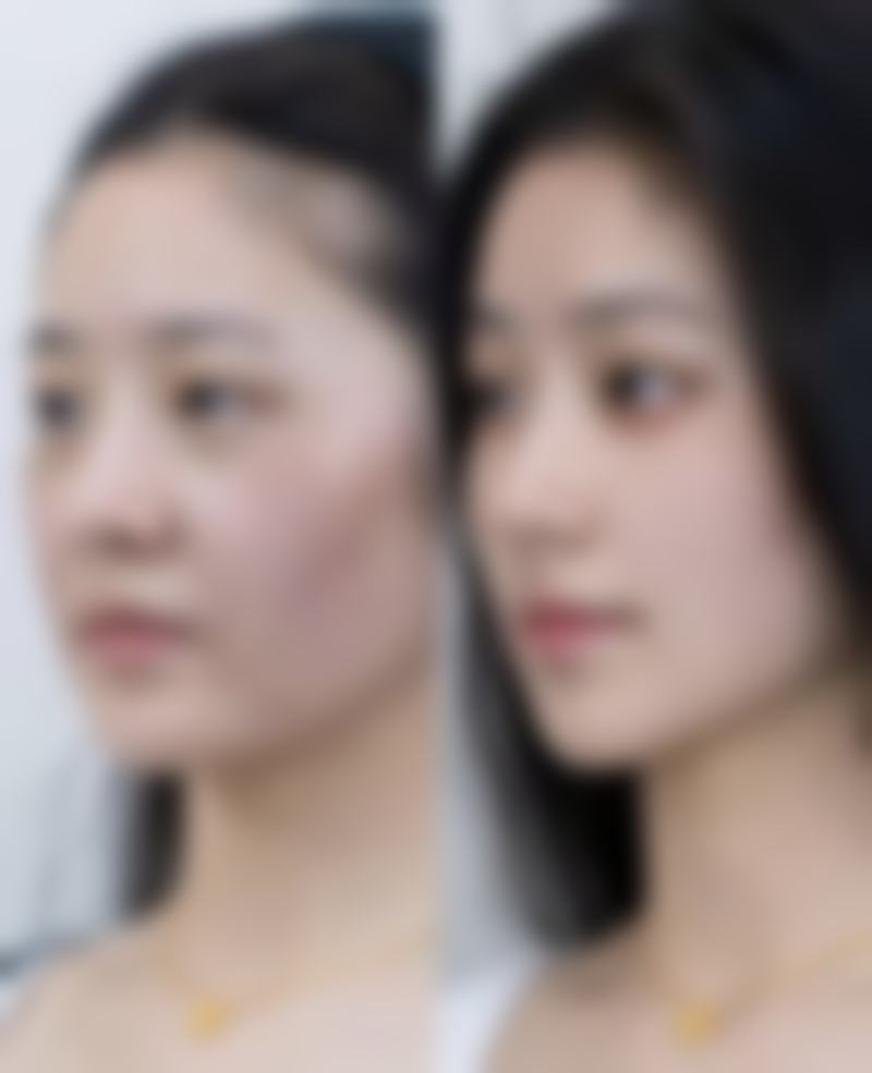 冰肉瘦脸针怎么样？总结与建议