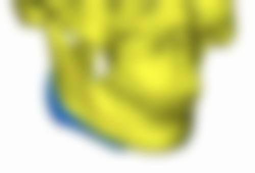 一、富贵包抽脂价格的影响因素