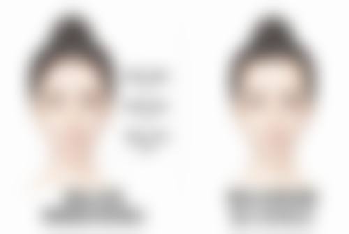 泪沟打成眼袋怎么办？了解打泪沟后遗症及有效改善方法很重要！ 