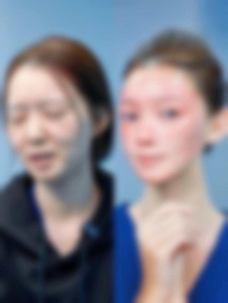 三、眼综合双眼皮的个性化设计