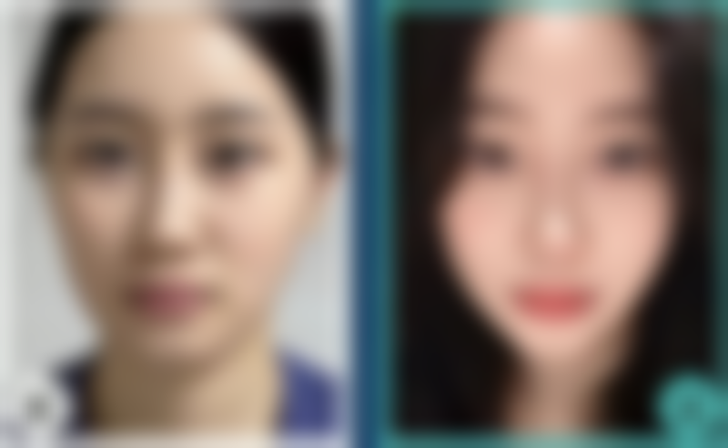 六、眼综合双眼皮的不同类型及适用人群