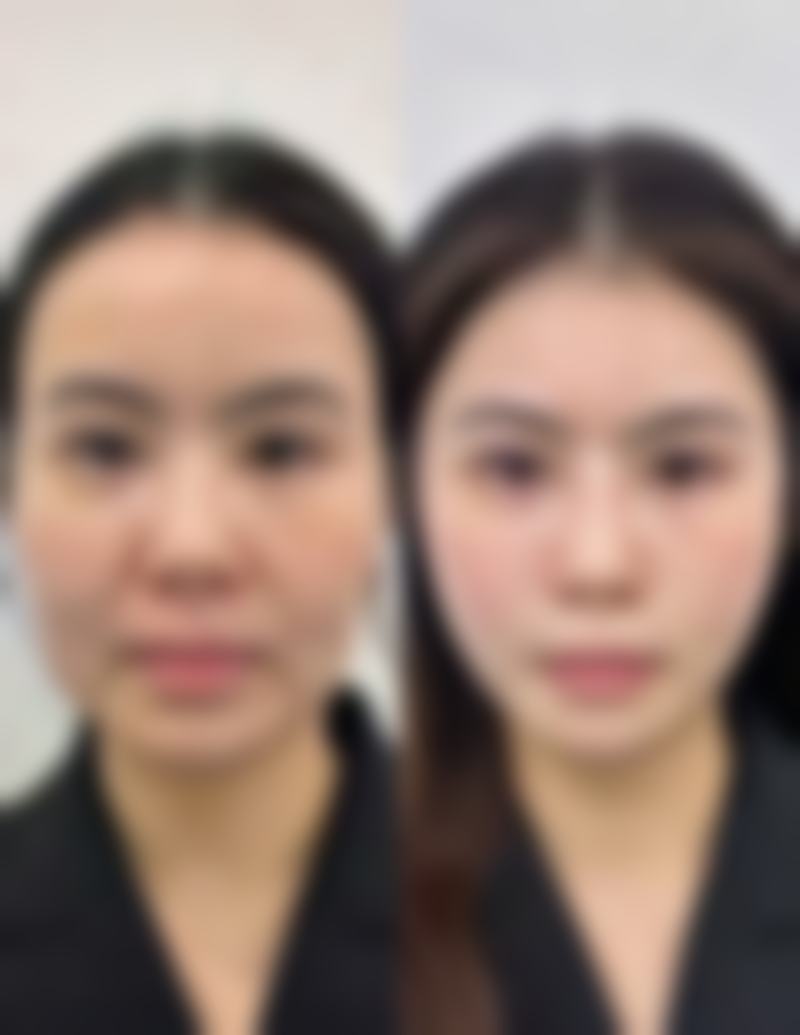 二、支持自然派观点：孟子义双眼皮是不是割的有不同声音