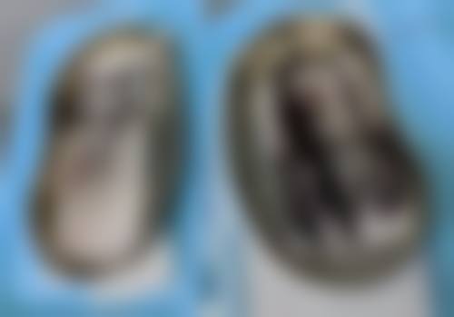 二、埋线双眼皮忌口时长