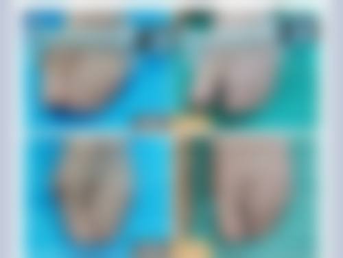 一、非侵入性拉皮除皱方法