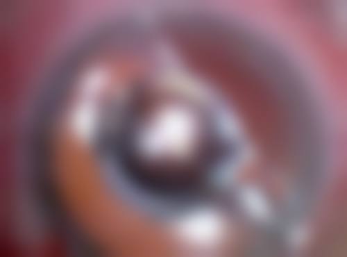 隆胸假体能在体内放多久？受材料、个体等因素影响时间差异大！ 