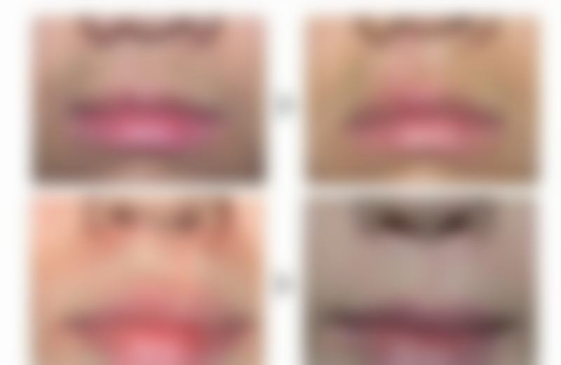 二、打除皱针的短期危害及应对