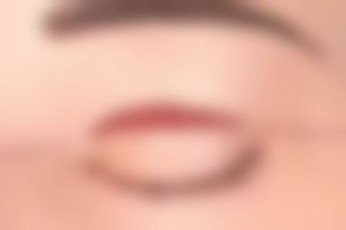 三、不同类型眼袋按摩的成效差异