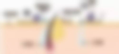 阴道紧缩术方法有哪些？多种常见术式解析，助你了解紧缩新途径 