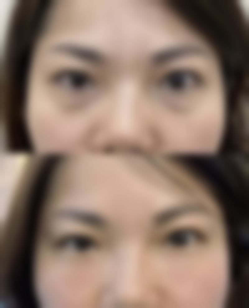 四、全切双眼皮不同修复阶段的护理重点