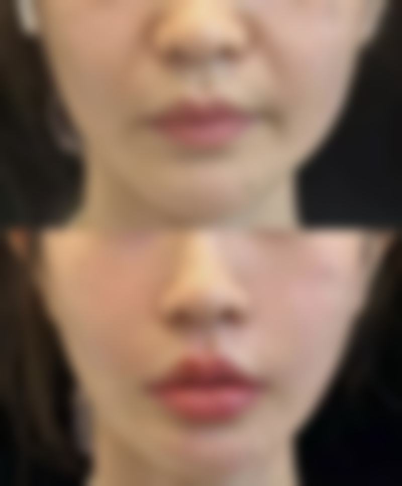 二、影响隆胸假体取出的因素