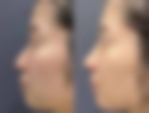 四、疤痕增生做光子嫩肤的成效