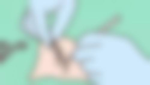 三、筋膜恒久无痕双眼皮的手术过程