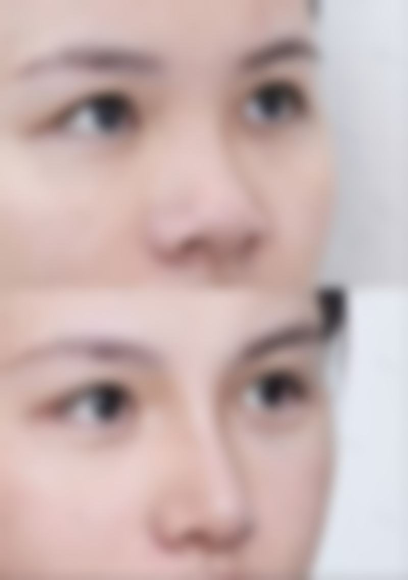 五、蒸汽眼罩能消除眼袋吗之不同改善方式对比