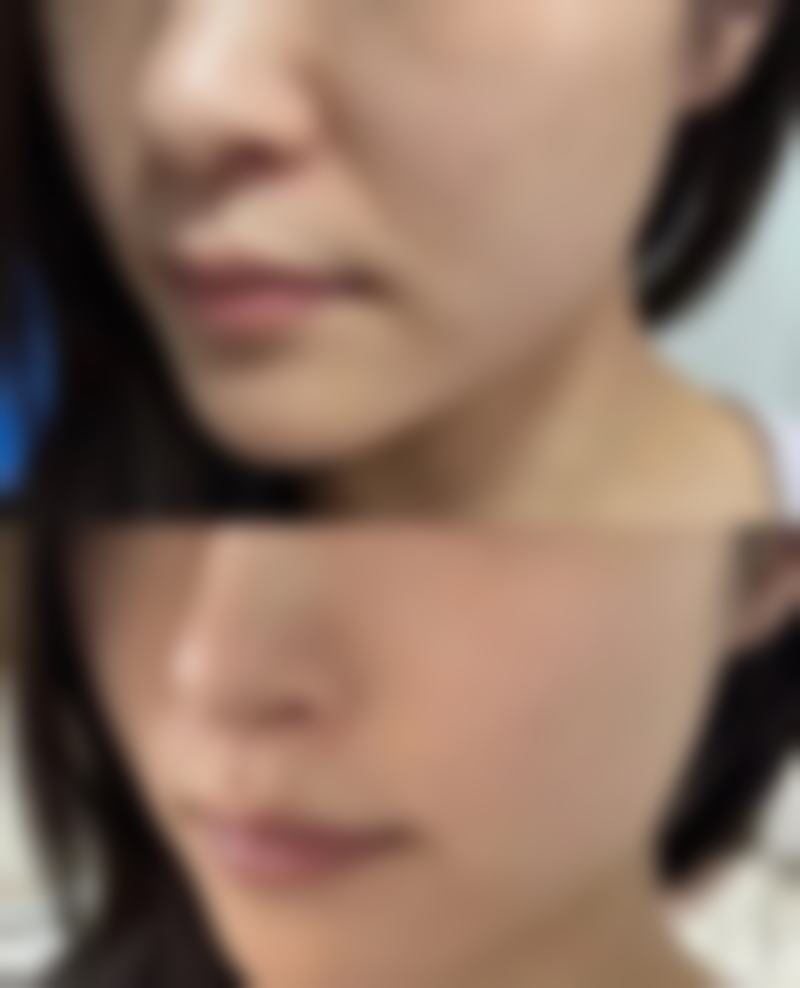 筋膜恒久无痕双眼皮是怎样做的?总结与展望