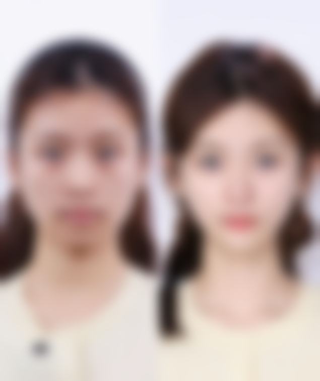 三、疤痕增生做光子嫩肤的注意事项