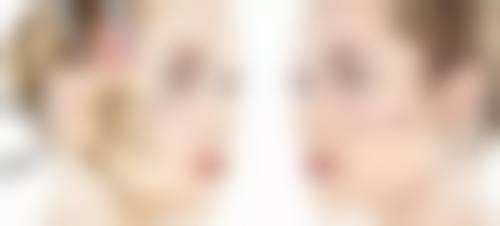 一、埋线双眼皮的基本情况