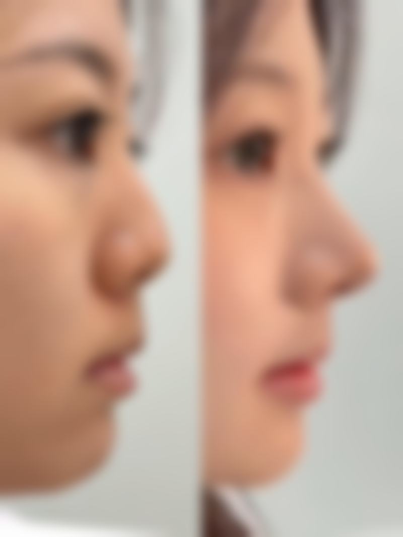 一、了解眼袋类型及按摩作用