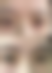 一、祛眼袋成效的影响因素