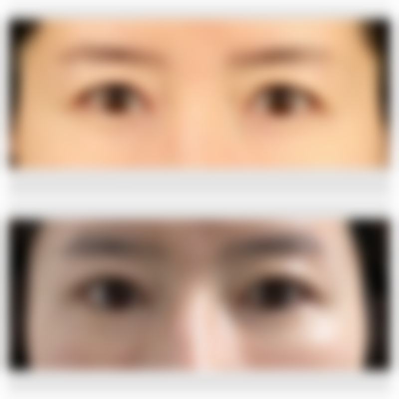 三、修复疤痕疙瘩的费用情况