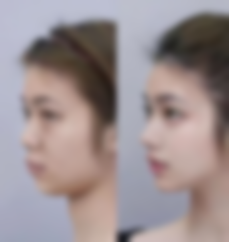 二、丰太阳穴可能存在的风险